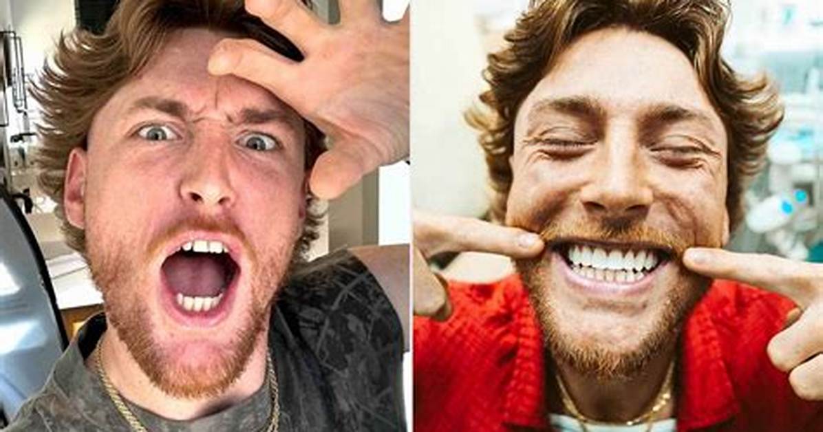 Bailey Zimmerman Reveals He Removed His Braces to Get Rid of His ‘Lisp’ When He Sang