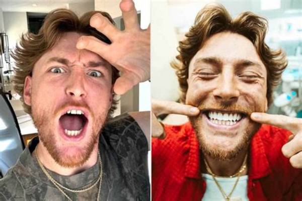 Bailey Zimmerman Reveals He Removed His Braces to Get Rid of His ‘Lisp’ When He Sang