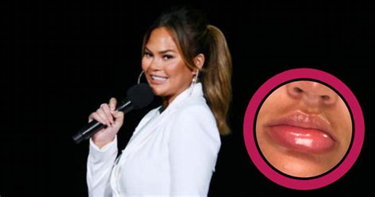 Chrissy Teigen Opens up About Painful Condition