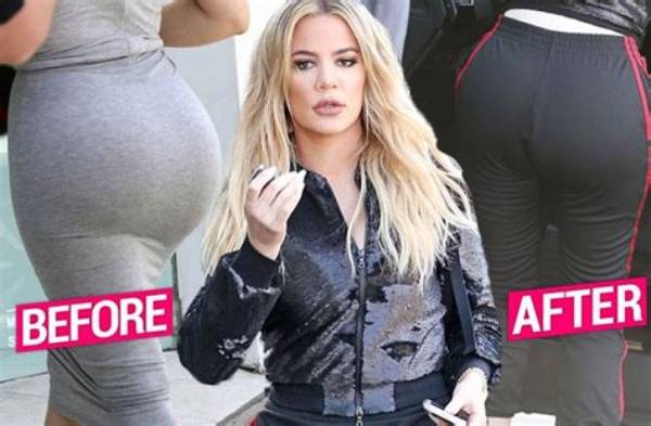Did Khloe Kardashian Get Her Implants Removed or Her Bbl Reversed?