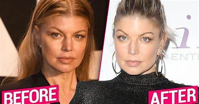 Fergie’s Alleged “Plastic Surgery Makeover” Cost $30,000: Was It Worth It?