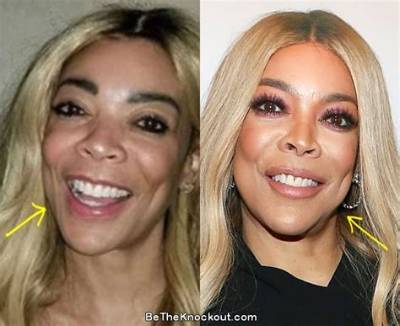 Has Wendy Williams Done Plastic Surgery? Fans Curious About Her Nose Job and Botox