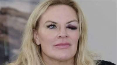 Heather Gay’s Black Eye Incident: What Causes Did Her Rhoslc Co-Stars Speculate? Details Explored