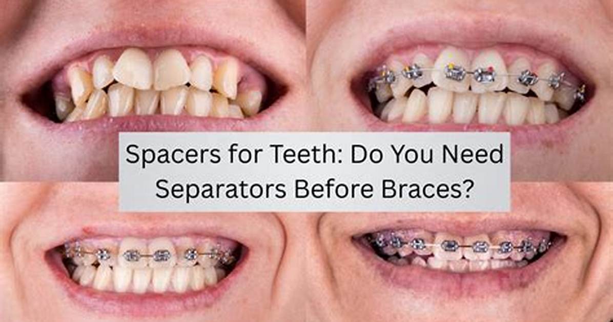 How Many Spacers Do I Need?