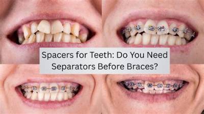 How Many Spacers Do I Need?