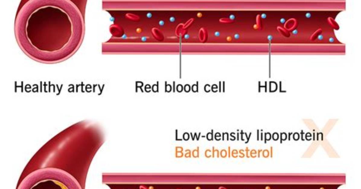 How Much Cholesterol Is in a Can of Tuna?