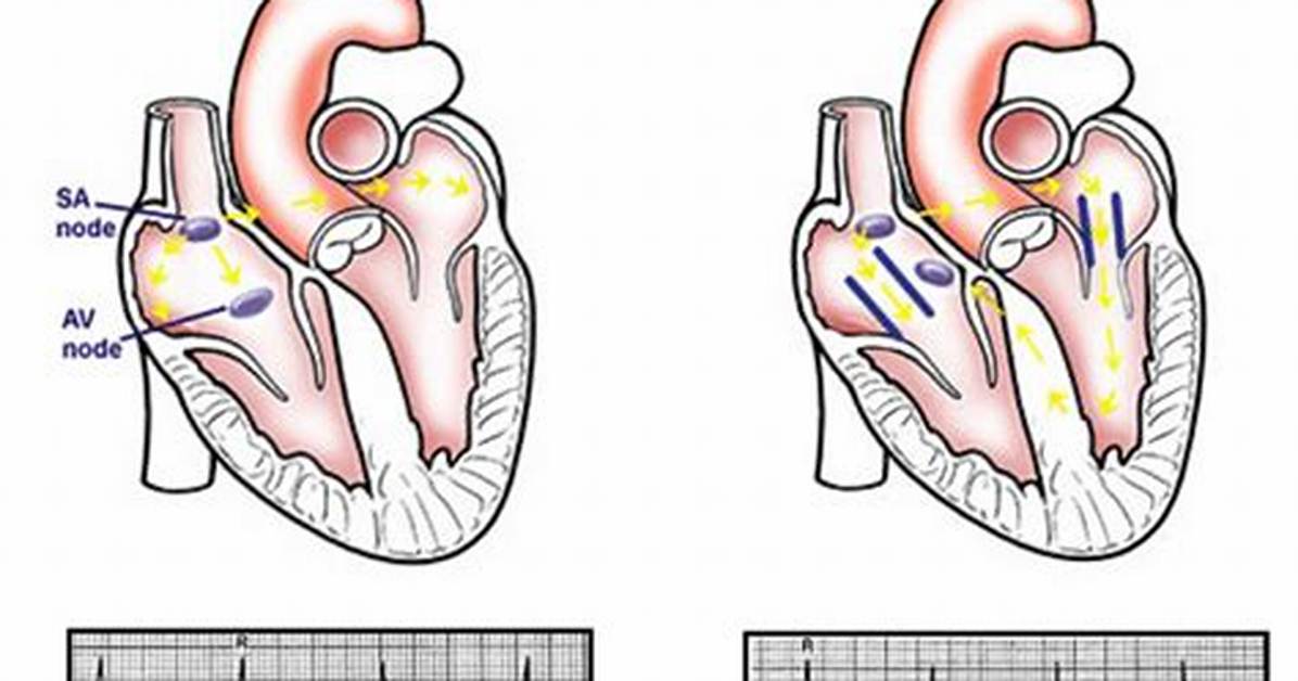Is Wolff Parkinson White Syndrome Dangerous?