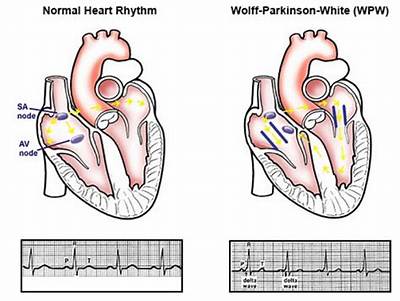 Is Wolff Parkinson White Syndrome Dangerous?