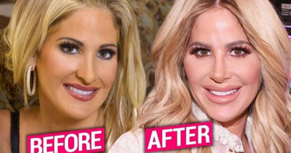 Kim Zolciak-Biermann Before Surgery Pics, Nose Job Age and Partner