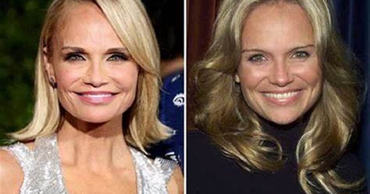 Kristin Chenoweth Botox and Lip Filler Plastic Surgery Before and After