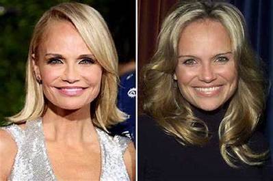 Kristin Chenoweth Botox and Lip Filler Plastic Surgery Before and After