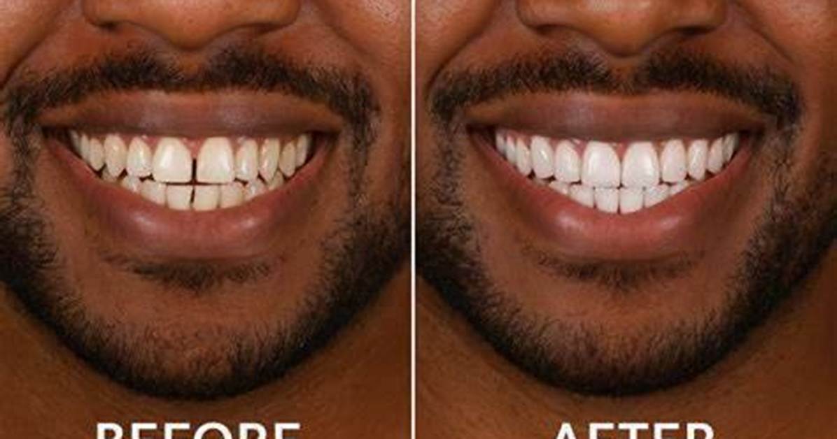 Linnocent Claims Her New Veneers Are Just Her Old Meth Teeth, Whitened