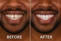 Linnocent Claims Her New Veneers Are Just Her Old Meth Teeth, Whitened