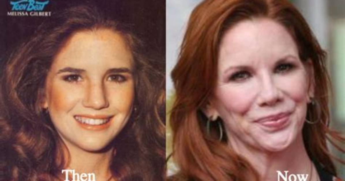 Melissa Gilbert’s Plastic Surgery: Too Noticeable?