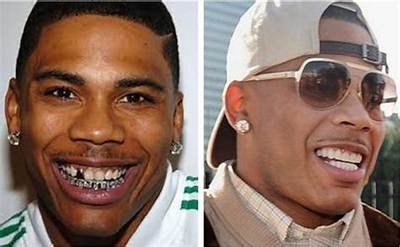 Nelly Lose Tooth, How Did Nelly Lose His Tooth?