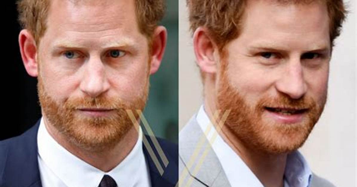 Prince Harry Losing His Hair Could Be from 'Tension with William and Charles'