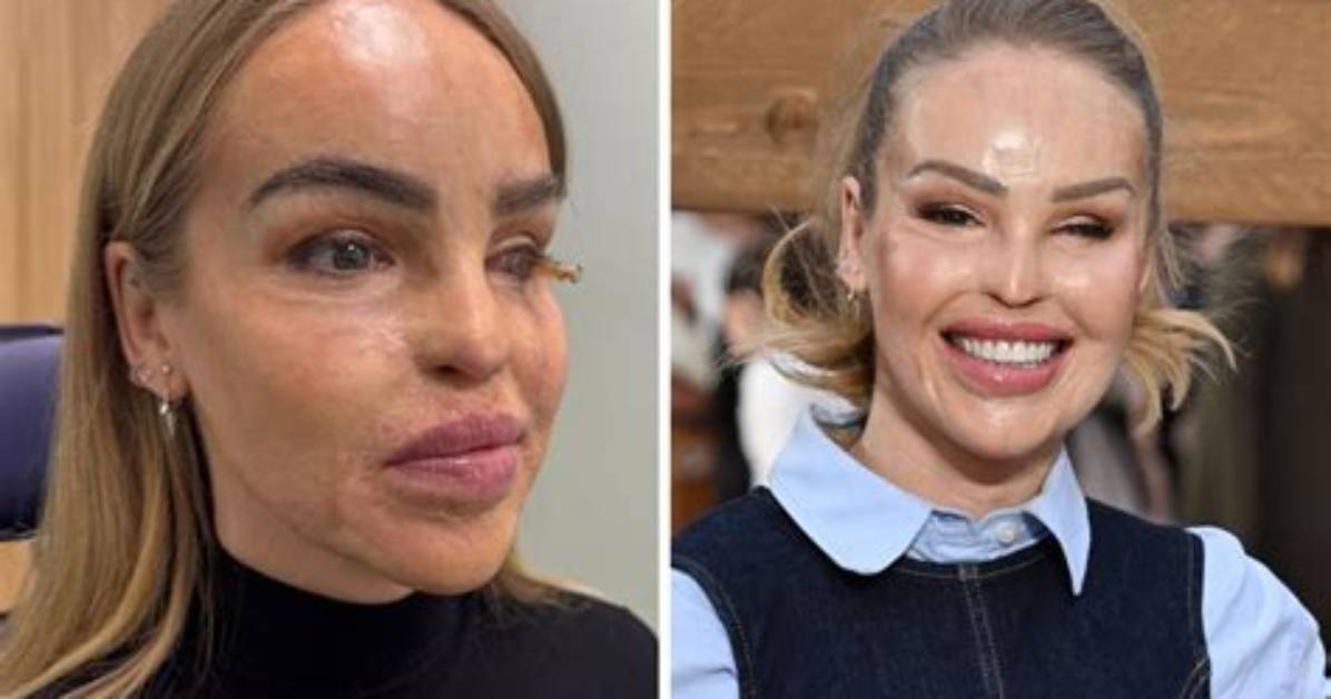 The Acid Attack Survivor Katie Piper Provides Update on Instagram About Her Gory Eye Surgery and May 2019 Sepsis!