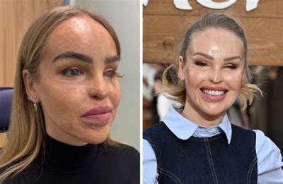 The Acid Attack Survivor Katie Piper Provides Update on Instagram About Her Gory Eye Surgery and May 2019 Sepsis!