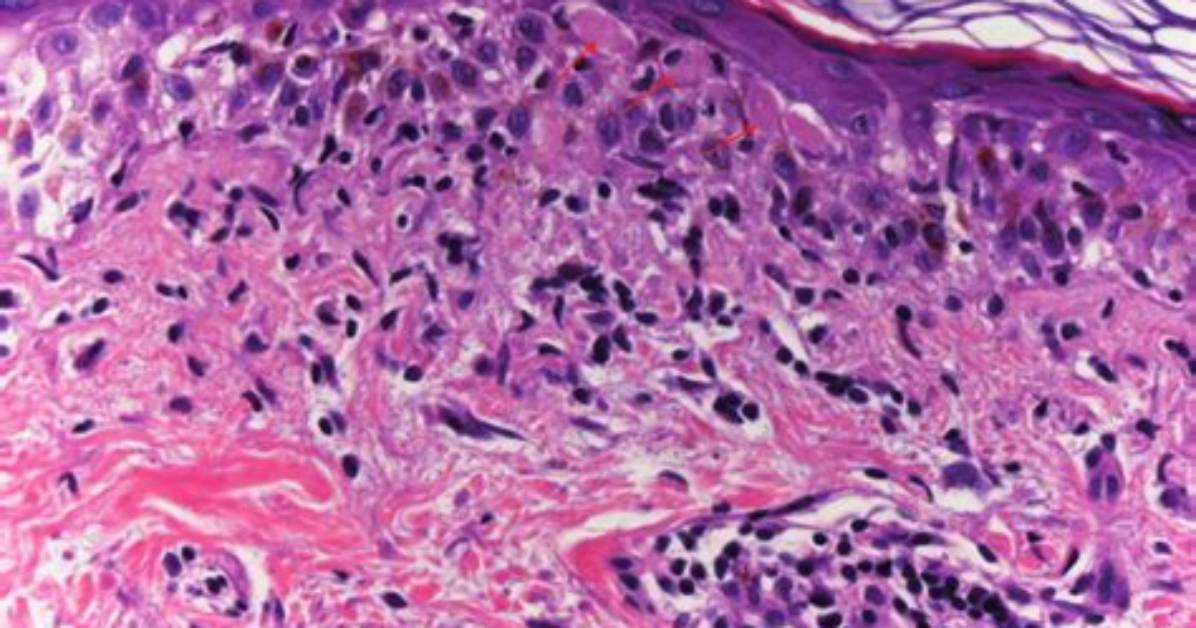 What Is a Lymphohistiocytic Infiltrate?