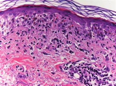 What Is a Lymphohistiocytic Infiltrate?