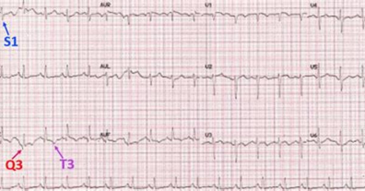 What Is S1Q3T3 in Ecg?