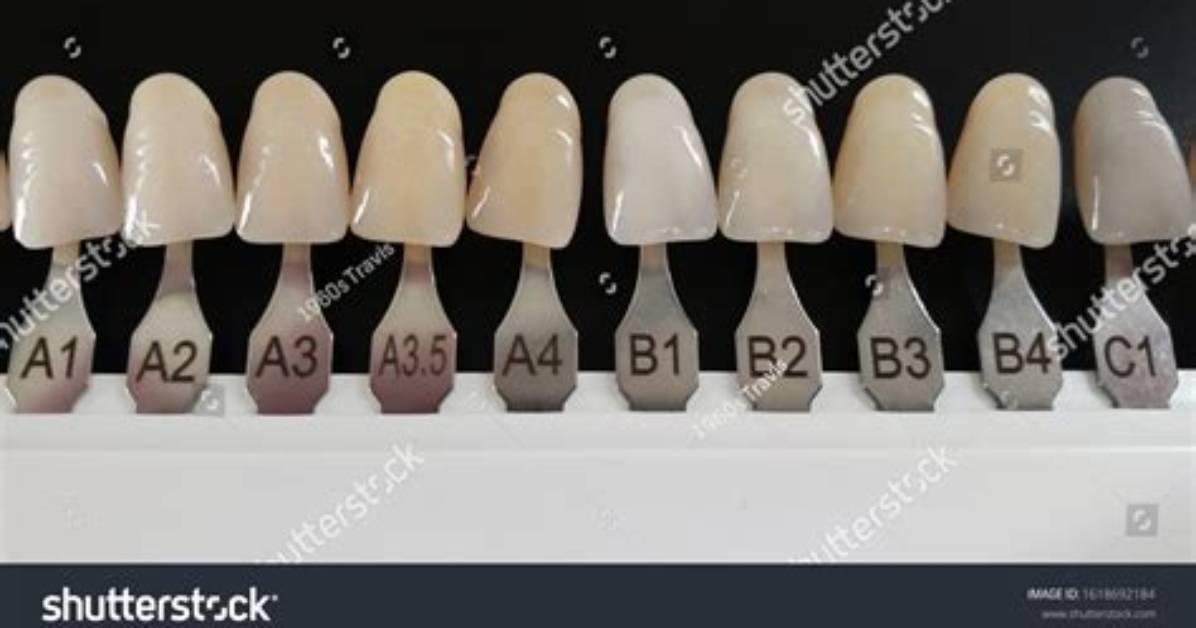 What Shade Is the Most Common Tooth Color?